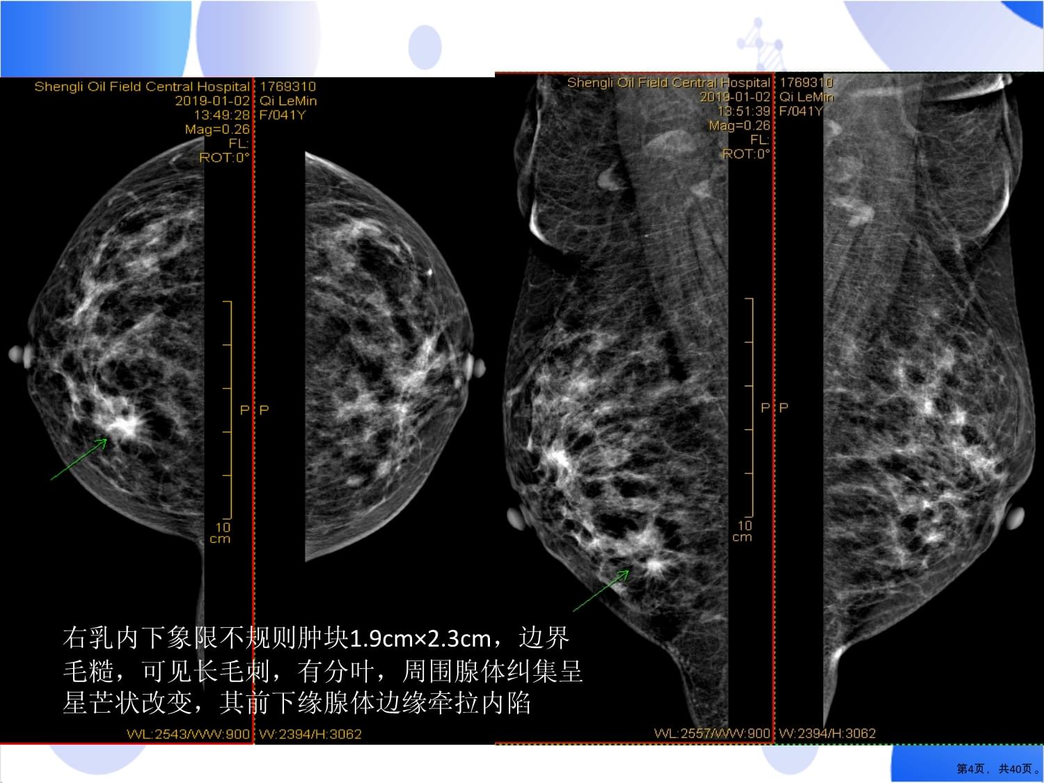 带蒂大网膜瓣乳腺癌保乳术后肿瘤整形技术课件_第4页