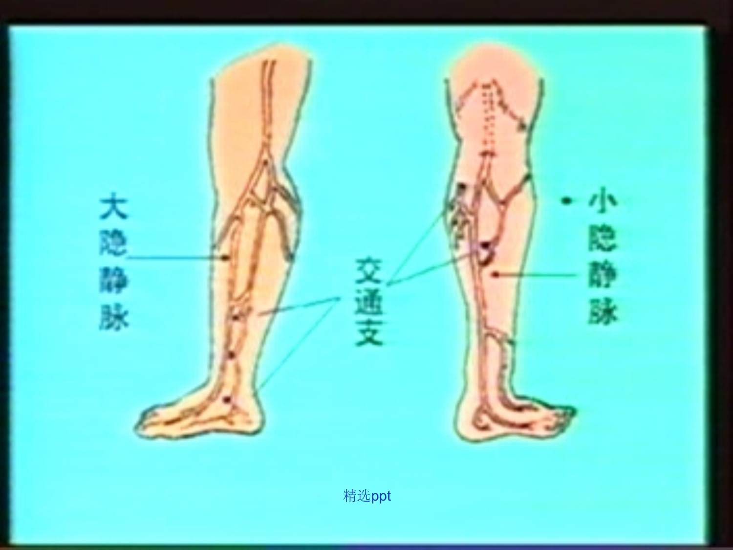 肢静脉曲张病人的护理_第4页