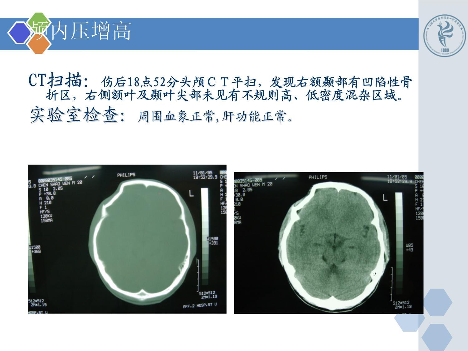 已编新颅脑损伤病例课件_第5页