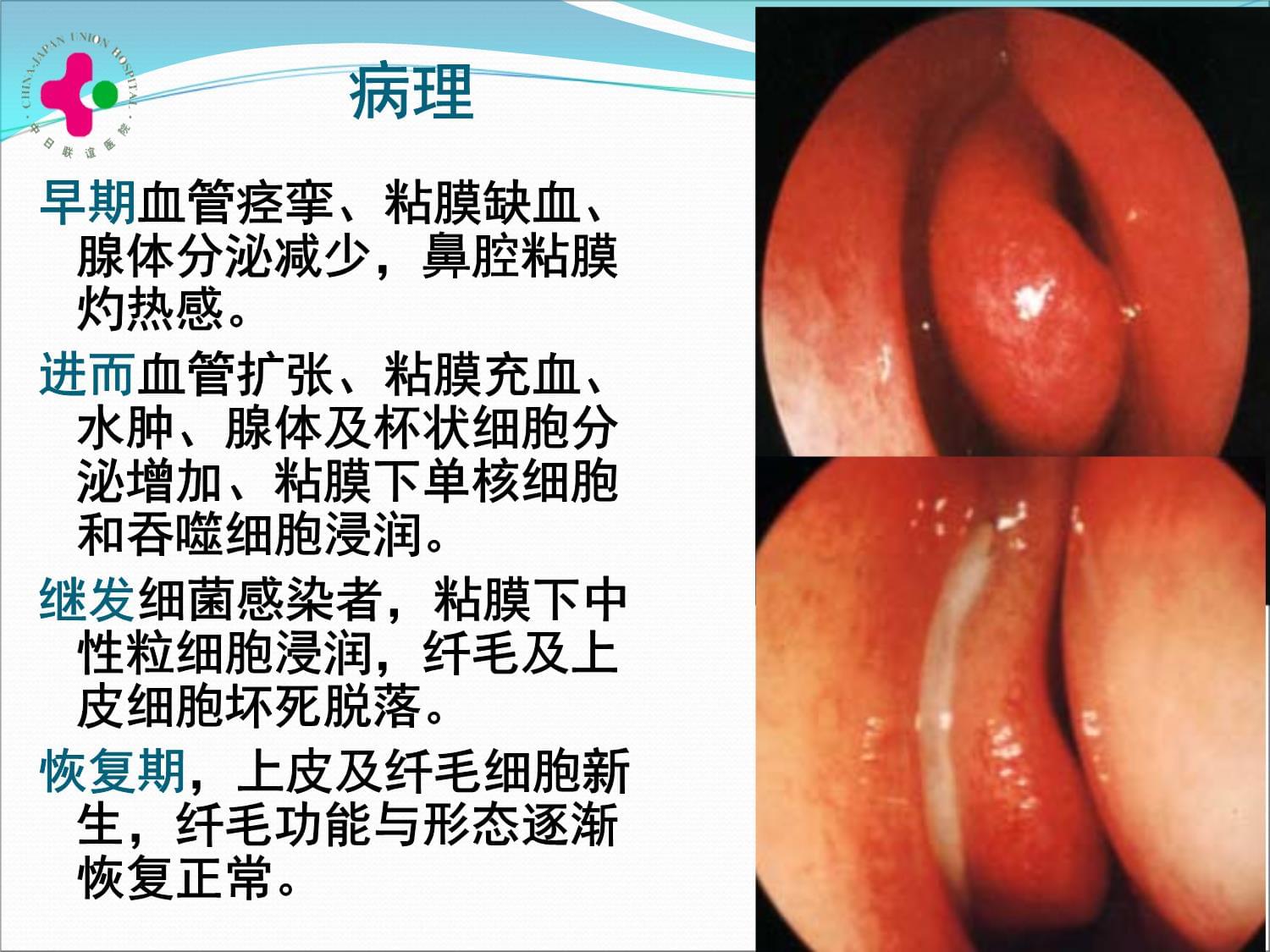 12011级临床口腔-慢性鼻炎变应性鼻炎鼻息肉-教室_第4页