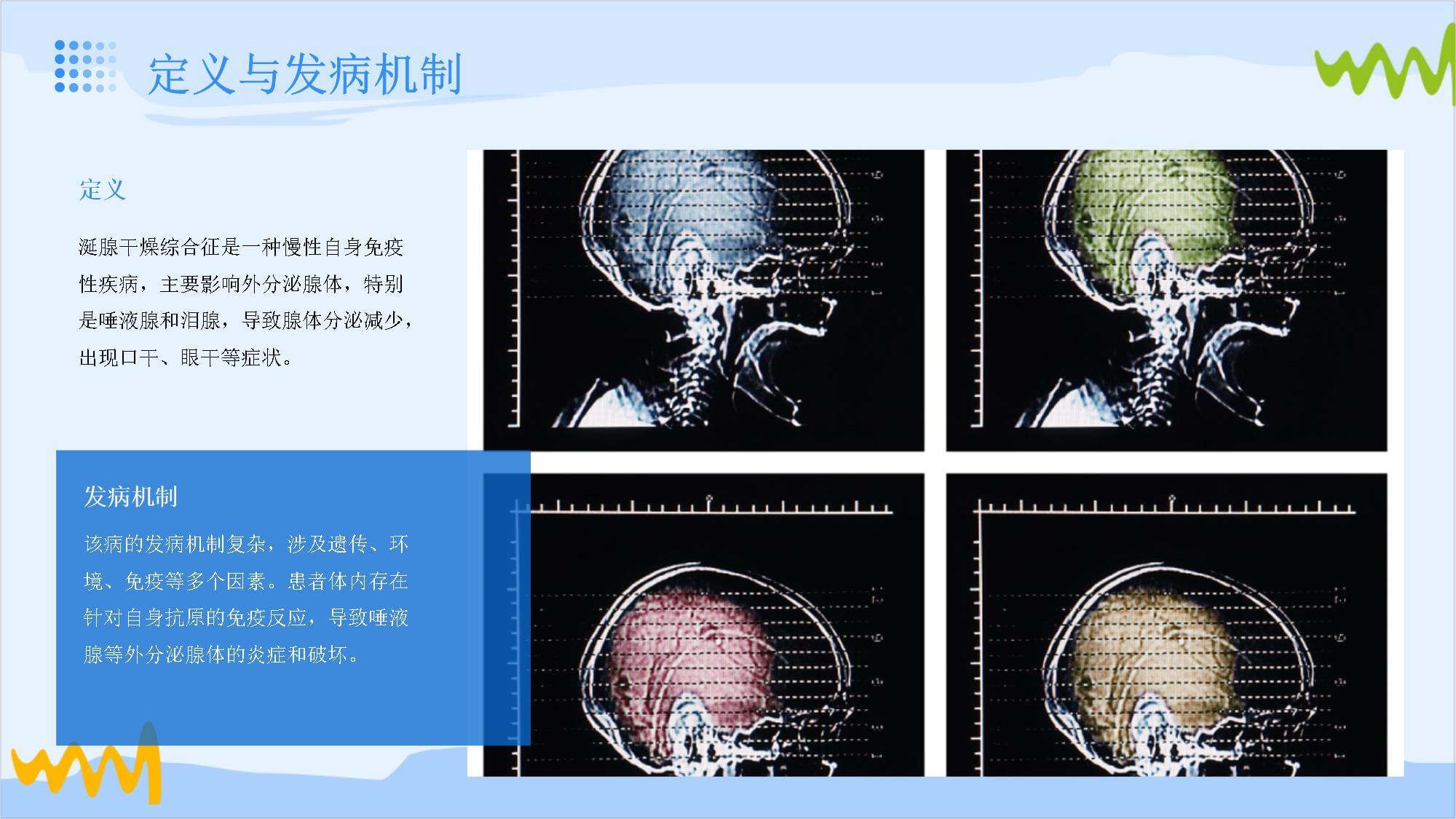 涎腺干燥综合征腮腺影像_第4页