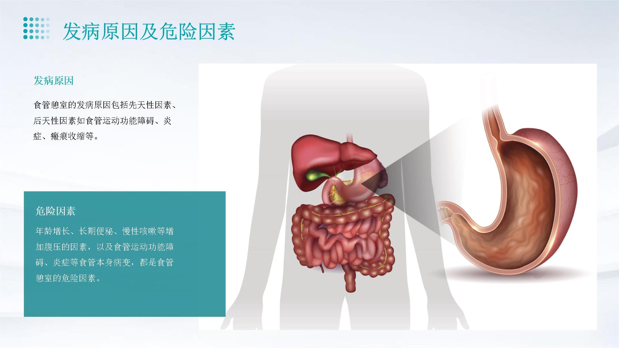 食管憩室术后护理_第5页